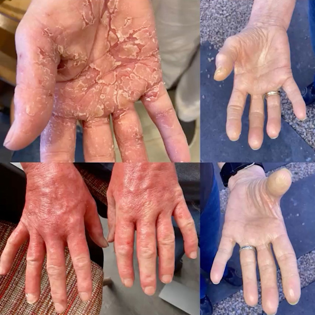 My Patient Reversed SEVERE ECZEMA with Medical Medium Information