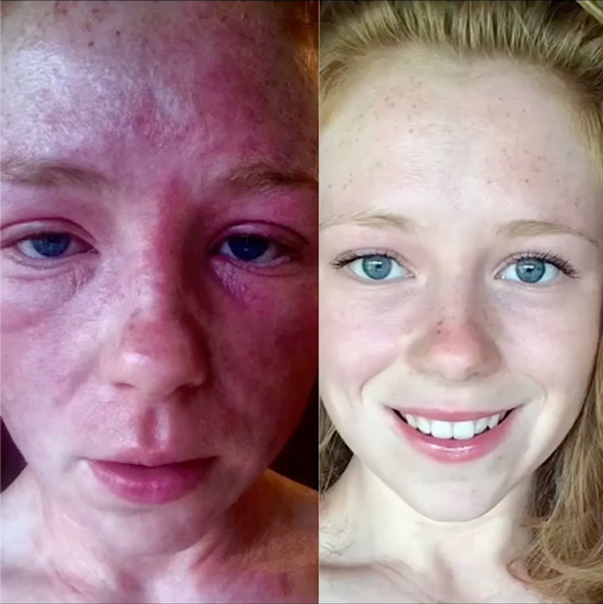 I Struggled With Eczema For Years